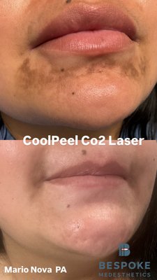 CoolPeel Co2 Resurfacing - After 3 CoolPeel CO₂ resurfacing sessions, this patient shows significant improvement in lower-face hyperpigmentation, with brighter, more even-toned skin and smoother texture—revealing a clearer, refreshed complexion. CoolPeel Co2 Resurfacing - After 3 CoolPeel CO₂ resurfacing sessions, this patient shows significant improvement in lower-face hyperpigmentation, with brighter, more even-toned skin and smoother texture—revealing a clearer, refreshed complexion.