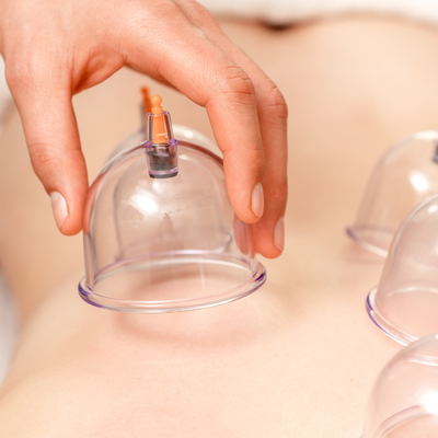 Cupping Therapy - Cupping is a type of treatment that has been used for thousands of years. Ancient Greek historian Herodotus recorded the use of cupping for indigestion, lung disease, headaches, and a variety of other ailments (1). The treatment works using suction generated through pumps or heat. Cups can be made from plastic, glass, clay, or even bamboo. Cupping Therapy - Cupping is a type of treatment that has been used for thousands of years. Ancient Greek historian Herodotus recorded the use of cupping for indigestion, lung disease, headaches, and a variety of other ailments (1). The treatment works using suction generated through pumps or heat. Cups can be made from plastic, glass, clay, or even bamboo.