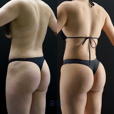 Body Procedures - With state-of-the-art facilities and a reputation for excellence, Galanis Plastic Surgery is the premier destination for those seeking transformative results with a focus on breast and body aesthetics. Trust us to help you achieve the confidence and beauty you deserve. Discover the difference with Galanis Plastic Surgery today.