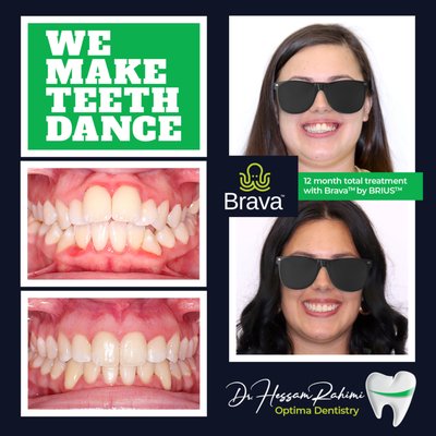 Straight in teeth in months not years - Introducing a groundbreaking 12-month treatment using Brava by BRIUS — a revolutionary technology that achieves faster teeth straightening compared to traditional braces. This innovative method moves teeth independently, and with Brava positioned discreetly behind the teeth, the treatment is not only subtle but also easier to maintain in terms of cleaning. Straight in teeth in months not years - Introducing a groundbreaking 12-month treatment using Brava by BRIUS — a revolutionary technology that achieves faster teeth straightening compared to traditional braces. This innovative method moves teeth independently, and with Brava positioned discreetly behind the teeth, the treatment is not only subtle but also easier to maintain in terms of cleaning.