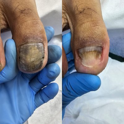 Nail Renewal: The Deep Cleaning Transformation Project - Toenail after being traumatized needs to be filed down because after many years, it gets thick and ugly🫣
When it's thick for many years, it starts to smell bad, can grow bacteria, and it stops growing because the dead cells of the nail and skin prevent new growth.
For this nail, first of all, needs nail deep cleaning.
My task is to free the nail, and give it a chance to grow back beautifully and smoothly. Nail Renewal: The Deep Cleaning Transformation Project - Toenail after being traumatized needs to be filed down because after many years, it gets thick and ugly🫣
When it's thick for many years, it starts to smell bad, can grow bacteria, and it stops growing because the dead cells of the nail and skin prevent new growth.
For this nail, first of all, needs nail deep cleaning.
My task is to free the nail, and give it a chance to grow back beautifully and smoothly.