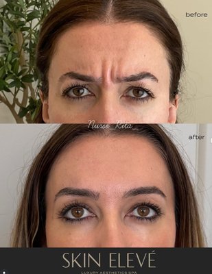 Dysport & Jeuveau (TOX) Treatments - We offer both Dysport and Jeuveau—advanced injectable treatments that smooth out fine lines and wrinkles for a naturally refreshed, youthful appearance. These treatments target the facial muscles responsible for dynamic wrinkles, such as frown lines, forehead lines, and crow’s feet.
How They Work
Dysport and Jeuveau are both forms of botulinum toxin type A, the same active ingredient found in Botox. Despite the different brand names, all three products work in the same way: they temporarily block nerve signals to specific muscles, reducing their movement and softening the appearance of lines.
Dysport
Known for its ability to spread slightly more than other brands, making it ideal for treating larger areas like the forehead.
Results may appear slightly faster—often within 2 to 3 days.
Delivers natural-looking, smooth results with proven performance.
Jeuveau
Often called “Newtox,” Jeuveau is the newest FDA-approved option, made exclusively for cosmetic use.
Offers a highly purified formula for precise, targeted results.
Jeuveau is currently the only vegan-friendly neuromodulator—a great option for those who prioritize plant-based or cruelty-free products.
Results typically appear within 3 to 5 days and last about 3 to 4 months.
What’s the Difference?
All three brands—Dysport, Jeuveau, and Botox—deliver similar results, but differ slightly in formulation, onset time, and how they spread in the tissue. Your provider will recommend the best option based on your individual goals, facial anatomy, and treatment areas.
Botox Is Just a Brand
While Botox is the most well-known name, it’s just one brand of botulinum toxin. Dysport and Jeuveau perform the same function and are equally effective when administered by an experienced injector. Choosing the right one comes down to personal preference, specific treatment goals, and professional guidance.
At Skin Elevé, our providers have extensive years of aesthetic experience and provide the best looking results for each individual. We are located in Chatsworth, Los Angeles, CA Dysport & Jeuveau (TOX) Treatments - We offer both Dysport and Jeuveau—advanced injectable treatments that smooth out fine lines and wrinkles for a naturally refreshed, youthful appearance. These treatments target the facial muscles responsible for dynamic wrinkles, such as frown lines, forehead lines, and crow’s feet.
How They Work
Dysport and Jeuveau are both forms of botulinum toxin type A, the same active ingredient found in Botox. Despite the different brand names, all three products work in the same way: they temporarily block nerve signals to specific muscles, reducing their movement and softening the appearance of lines.
Dysport
Known for its ability to spread slightly more than other brands, making it ideal for treating larger areas like the forehead.
Results may appear slightly faster—often within 2 to 3 days.
Delivers natural-looking, smooth results with proven performance.
Jeuveau
Often called “Newtox,” Jeuveau is the newest FDA-approved option, made exclusively for cosmetic use.
Offers a highly purified formula for precise, targeted results.
Jeuveau is currently the only vegan-friendly neuromodulator—a great option for those who prioritize plant-based or cruelty-free products.
Results typically appear within 3 to 5 days and last about 3 to 4 months.
What’s the Difference?
All three brands—Dysport, Jeuveau, and Botox—deliver similar results, but differ slightly in formulation, onset time, and how they spread in the tissue. Your provider will recommend the best option based on your individual goals, facial anatomy, and treatment areas.
Botox Is Just a Brand
While Botox is the most well-known name, it’s just one brand of botulinum toxin. Dysport and Jeuveau perform the same function and are equally effective when administered by an experienced injector. Choosing the right one comes down to personal preference, specific treatment goals, and professional guidance.
At Skin Elevé, our providers have extensive years of aesthetic experience and provide the best looking results for each individual. We are located in Chatsworth, Los Angeles, CA