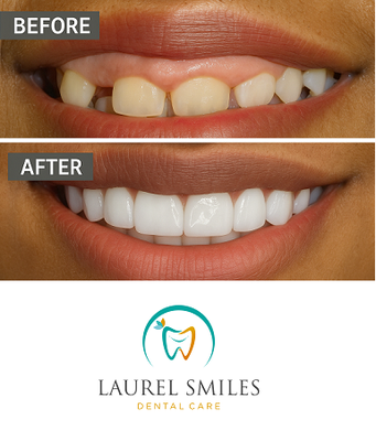 Hybrid Smile Makeover - Two patients, two incredible hybrid smile makeovers — and results that speak for themselves. Imagine what we can do for your smile — schedule your appointment now!