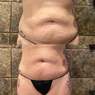 Body Contouring - Amazing results of Body contouring our client was consistent and in 3 sessions she was able to achieve this unbelievable results. Body Contouring - Amazing results of Body contouring our client was consistent and in 3 sessions she was able to achieve this unbelievable results.