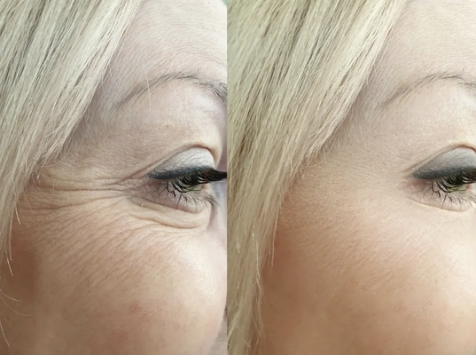 Before & After Photos - Transform your look at Beautiful Body & Face Spa! Check out our stunning before-and-after photos showcasing real results from our expert treatments. Whether you’re looking for smoother skin, a youthful glow, or body contouring, we’re here to help you feel your best.
✨ Special Offer: New clients enjoy 15% off your first treatment! ✨
Book your free consultation today and let’s create the results you’ve always wanted! Before & After Photos - Transform your look at Beautiful Body & Face Spa! Check out our stunning before-and-after photos showcasing real results from our expert treatments. Whether you’re looking for smoother skin, a youthful glow, or body contouring, we’re here to help you feel your best.
✨ Special Offer: New clients enjoy 15% off your first treatment! ✨
Book your free consultation today and let’s create the results you’ve always wanted!