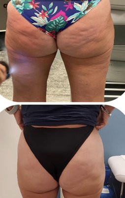 Cryo Slimming/Contouring - This amazing service helps clients tighten skin and reduce fat on their bodies.