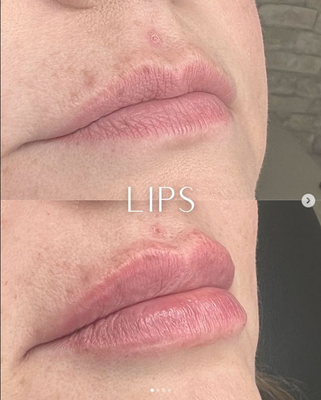 Cosmetic Injectables - Cosmetic Non-Surgical Wrinkle Reductions, Dermal Fillers, and Lip Enhancements at Youthful Solutions MediSpa. Cosmetic Injectables - Cosmetic Non-Surgical Wrinkle Reductions, Dermal Fillers, and Lip Enhancements at Youthful Solutions MediSpa.