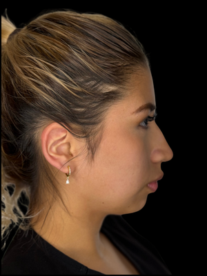 Rhinoplasty & Chin - This patient wanted to improve her overall profile and required a tip rhinoplasty and chin implant. Now she has an amazing profile! Rhinoplasty & Chin - This patient wanted to improve her overall profile and required a tip rhinoplasty and chin implant. Now she has an amazing profile!
