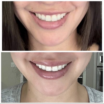 Lip Flip Before and After - Lip Flip provided by one of our Artists