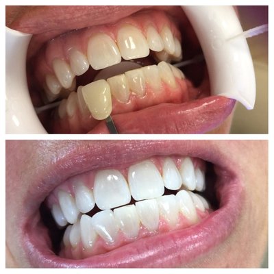 Teeth Whitening - n-Office Bleaching usually requires only one office visit. A protective gel or a rubber shield is placed over the gums to protect the soft tissue. A bleaching agent containing carbamide peroxide is applied to the teeth, and a specialized light is then used to enhance the action of the whitening agent. This is the fastest way to achieve results.
To learn more please visit out website Teeth Whitening - n-Office Bleaching usually requires only one office visit. A protective gel or a rubber shield is placed over the gums to protect the soft tissue. A bleaching agent containing carbamide peroxide is applied to the teeth, and a specialized light is then used to enhance the action of the whitening agent. This is the fastest way to achieve results.
To learn more please visit out website