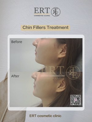 Filler Treatment - These are the result of filler injection treatments Filler Treatment - These are the result of filler injection treatments