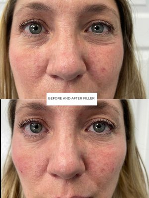 Undereye Filler - Before And After Undereye Filler
