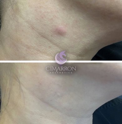 Acne Eraser - Acne injections, sometimes referred to as corticosteroid injections, typically involve the use of corticosteroid medications like Kenalog. These injections are a treatment option for certain types of acne, particularly cystic acne or severe inflammatory acne lesions.

Here’s how Kenalog injections for acne work:

Inflammation Reduction: Cystic acne lesions are deeply inflamed and can be painful. Corticosteroid injections help reduce inflammation rapidly.

Fast Resolution: The injection is administered directly into the acne lesion, and the corticosteroid works quickly to reduce inflammation and the size of the lesion. Many people see a noticeable improvement within a day or two.

Prevention of Scarring: By reducing inflammation and shrinking the acne cyst, corticosteroid injections can help prevent scarring that might occur if the cyst were to rupture or become more severe.
