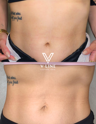 Non-Surgical Body Contouring - We offer all kinds of non-surgical body contouring treatments with top notch FDA approved technology. Fat burning, fat cell removal, muscle building, skin tightening, cellulite reduction and etc.
Call us today for a free consultation @626-7010-2888 or you can message us on Yelp at anytime. Non-Surgical Body Contouring - We offer all kinds of non-surgical body contouring treatments with top notch FDA approved technology. Fat burning, fat cell removal, muscle building, skin tightening, cellulite reduction and etc.
Call us today for a free consultation @626-7010-2888 or you can message us on Yelp at anytime.