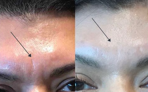 Botox & Dysport - Cosmetic injection treatments with Botox & Dysport is quick, safe, and effective in reducing fine lines.  Botox treats fine lines and wrinkles by relaxing key muscle fibers for months at a time. Botox is recommended every 3-4mos and works to gradually reduce fine lines over time.

At your visit our team will answer any questions and create a clear treatment plan for you with units and pricing. Botox treatment at our office is only a 30 minute visit with either Dr. Ardila or one of our nurse providers. During your visit we will start with a consult. Before any treatment we will discuss price, answer any questions, and review the expected results.

Common areas Botox can be used to treat:

Frown lines (in between the brow area)
Forehead lines
Crows feet (around the corners of the eyes)
Lip flip Bunny lines
Corners of the lips/above lips

Ready to look and feel your best?
We’re here to help. Our consults are always a free and a great way to get started.

Book your next appointment or consultation by calling or visiting our website today!