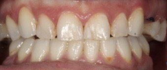 Smile Design - This patient wanted to feel more confident about her smile. By replacing her missing teeth and creating customized crowns she helped design, this patient now loves to share her smile Smile Design - This patient wanted to feel more confident about her smile. By replacing her missing teeth and creating customized crowns she helped design, this patient now loves to share her smile