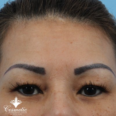 Botox Treatment - This patient received about 35 units of Botox and noticed improvement after 14 days. Botox Treatment - This patient received about 35 units of Botox and noticed improvement after 14 days.