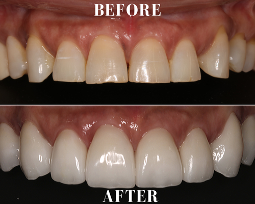 Crowns and Veneers - A sample of some work that is easily achievable in a few visits and takes about a month. Please call for a consult to see how we can transform your smile! Crowns and Veneers - A sample of some work that is easily achievable in a few visits and takes about a month. Please call for a consult to see how we can transform your smile!