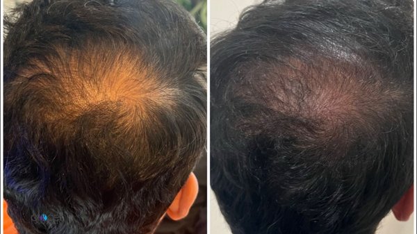 Hair Loss Treatment - Award winning customized hair restoration treatment using advanced medical-grade microchanneling combined with a stem cell–based growth serum. The treatment stimulates the scalp’s natural healing response, improves blood flow, activates hair follicles, and supports new hair growth while strengthening existing strands.

Microchanneling creates precise micro-pathways in the scalp to allow deeper penetration of regenerative growth factors and stem cell technology, helping improve hair density, thickness, and overall scalp health with minimal downtime.

Treatment was performed by a licensed registered nurse in a private clinical setting.