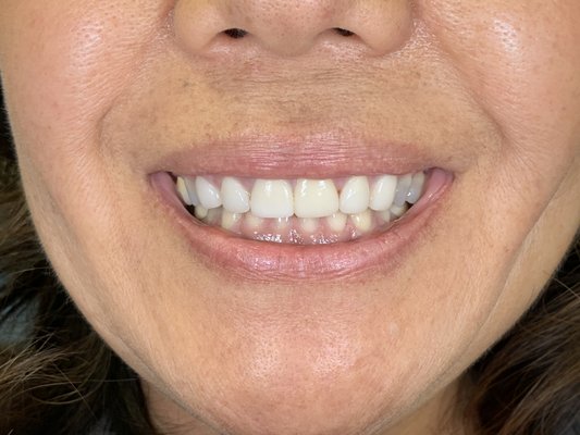 Replacing Old Cosmetic Dentistry - This client didn't like how her old veneers looked. She always thought they were too short and she wanted whiter teeth. After removing her old veneers, we made her temporary teeth (prototypes of her new smile). We then made adjustments on the temporaries until she approved. The final restorations are based off the prototypes that were fine tuned what she wanted. Replacing Old Cosmetic Dentistry - This client didn't like how her old veneers looked. She always thought they were too short and she wanted whiter teeth. After removing her old veneers, we made her temporary teeth (prototypes of her new smile). We then made adjustments on the temporaries until she approved. The final restorations are based off the prototypes that were fine tuned what she wanted.