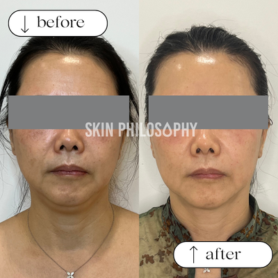 Thermage® FLX Facial & Neck - ADDRESS THE VISIBLE SIGNS OF AGING IN MINUTES
The Thermage® system is a non-invasive radiofrequency (RF) therapy that can help smooth, tighten and contour skin for an overall younger-looking Thermage® FLX Facial & Neck - ADDRESS THE VISIBLE SIGNS OF AGING IN MINUTES
The Thermage® system is a non-invasive radiofrequency (RF) therapy that can help smooth, tighten and contour skin for an overall younger-looking