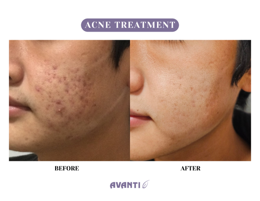 Acne Treatment - Our Acne Treatment gallery showcases the transformative outcomes experienced by our clients at Avanti Laser Clinic. From stubborn breakouts to clearer, smoother skin, these before and after images highlight the effectiveness of our personalized acne treatment plans. Each treatment is tailored to target the root cause of acne, combining advanced laser therapy, medical-grade products, and expert care to help you achieve lasting, visible results. Explore our gallery and see the difference Avanti Laser Clinic can make for your skin! Acne Treatment - Our Acne Treatment gallery showcases the transformative outcomes experienced by our clients at Avanti Laser Clinic. From stubborn breakouts to clearer, smoother skin, these before and after images highlight the effectiveness of our personalized acne treatment plans. Each treatment is tailored to target the root cause of acne, combining advanced laser therapy, medical-grade products, and expert care to help you achieve lasting, visible results. Explore our gallery and see the difference Avanti Laser Clinic can make for your skin!