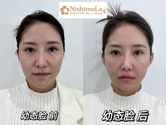 Dream Filler - The world of beauty is continually evolving, and fillers have become a fascinating avenue for individuals to enhance their features and embrace their confidence in a way that feels comfortable and empowering!