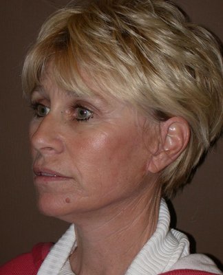 Face Lift - Dr. Kenneth Bermudez can achieve significant facial rejuvenation results by performing facelift surgery in San Francisco. His patients can turn back the hands of time with this procedure, which is designed to reduce the effects of aging, gravity, sun exposure, and stress and to give patients a younger, fresher appearance. Good candidates for facelift surgery include men and women with a strong bone structure, supple skin, and realistic expectations. Please continue reading to learn more about facelift with Dr. Kenneth Bermudez. Face Lift - Dr. Kenneth Bermudez can achieve significant facial rejuvenation results by performing facelift surgery in San Francisco. His patients can turn back the hands of time with this procedure, which is designed to reduce the effects of aging, gravity, sun exposure, and stress and to give patients a younger, fresher appearance. Good candidates for facelift surgery include men and women with a strong bone structure, supple skin, and realistic expectations. Please continue reading to learn more about facelift with Dr. Kenneth Bermudez.