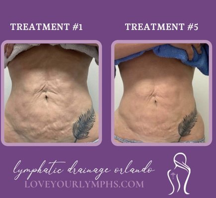 Testimonials - Everyday there are more and more patients experiencing the benefits of lymphatic drainage wee why! Testimonials - Everyday there are more and more patients experiencing the benefits of lymphatic drainage wee why!