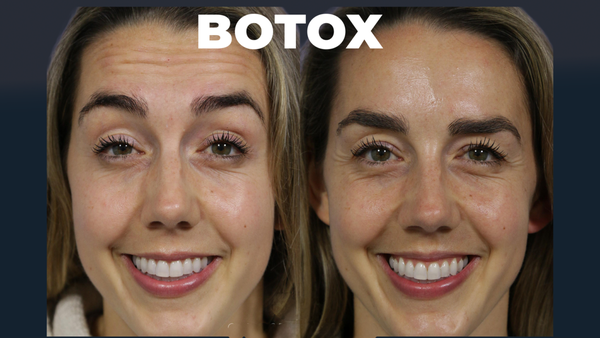 Botox - all FDA-approved neurotoxins - At our Marina del Rey practice serving Los Angeles and Santa Monica, we offer BOTOX® Cosmetic, Dysport®, XEOMIN®, Jeuveau®, and DAXXIFY®—all FDA-approved neurotoxins that are designed to reduce the appearance of wrinkles caused by the repeated movement of facial muscles. Over time, as you laugh, smile, and frown, contractions of these muscles create lines and wrinkles on the face known as dynamic wrinkles. With carefully placed injections, we use neurotoxins to block nerve impulses to the muscles that are causing dynamic wrinkles. This relaxes the muscles and allows the skin to lay smooth.