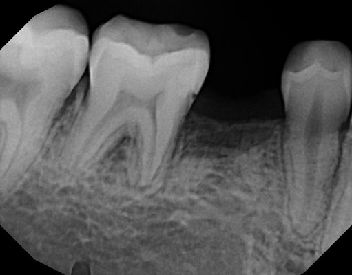 Dental Implant - Missing teeth? We can Help! Call now and get your consultation X-Rays. Dental Implant - Missing teeth? We can Help! Call now and get your consultation X-Rays.