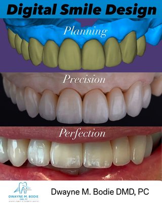 Smile makeovers using modern digital dentistry - These cases were all done with digital smile design. Beautiful natural looking teeth designed by amazing ceramists. We 3D print and show you a tryin of the final results before even starting your treatment. Ready to transform your smile and your life? Contact us today.