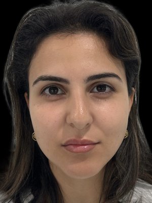 Before and After - Depending on your preference, lip filler can add much volume, a small amount, or anywhere between. With this patient, she wanted to give her lips a small amount of added plumpness while maintaining a natural look. Before and After - Depending on your preference, lip filler can add much volume, a small amount, or anywhere between. With this patient, she wanted to give her lips a small amount of added plumpness while maintaining a natural look.