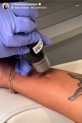 Tattoo Removal - PicoSure Pro Laser; Only FDA approved for Tattoo removal and treating Melasma and dark pigment corrections.We offer large array of laser services