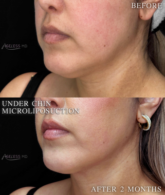 Under Chin Micro Lipo - Micro-liposuction can be performed under the chin and along the jawline ("wings") to precisely target and remove small pockets of fat, enhancing contour and definition. This minimally invasive procedure helps create a more sculpted, refined profile with long-lasting results. Under Chin Micro Lipo - Micro-liposuction can be performed under the chin and along the jawline ("wings") to precisely target and remove small pockets of fat, enhancing contour and definition. This minimally invasive procedure helps create a more sculpted, refined profile with long-lasting results.