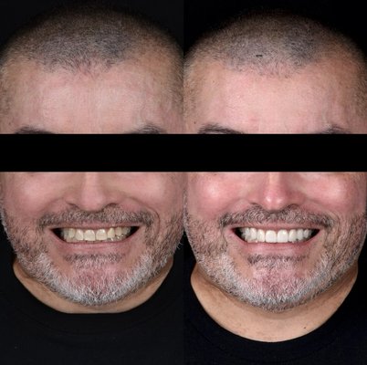 Before after with porcelain veneers - Full mouth cosmetic rehabilitation with porcelain veneers Before after with porcelain veneers - Full mouth cosmetic rehabilitation with porcelain veneers