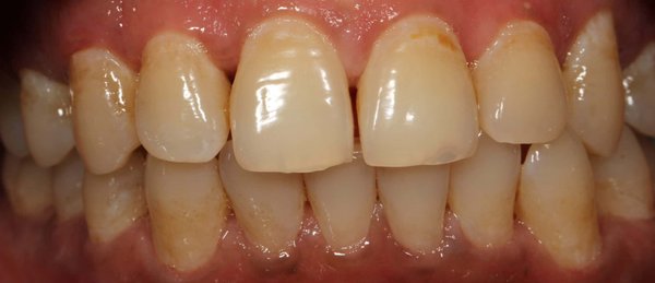 Same Day Whitening - This is a typical whitening procedure that takes approximately 90 minutes.  The same results can be achieved with custom take-home trays, which slowly whiten the teeth over a few weeks.