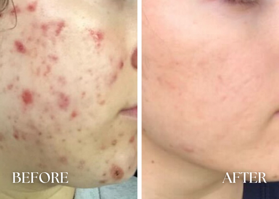 Say Goodbye to Your Acne ACNE BOOT CAMP - Clearer Skin in Six Weeks
What is Facial Lounge's Acne Boot Camp?
Facial Lounge’s Acne Boot Camp is a structured 6-week program supporting your transformation to clear, confident skin. Come in once a week for a targeted Mini LED Blue Light Facial and receive a curated bundle of professional skincare—hand-selected by owner and expert, Amber Rose Johnson.
Program Details
Six Mini LED Blue Light Facials
($834 value)
Deep cleansing, gentle extractions, LED therapy, and targeted acne treatment each week.
Personalized Skincare Products (included):
4 oz Pore Clarifying Cleanser ($39 value)
Oil-Free Moisturizer ($44 value)
Sulfur Mask ($39 value)
For a full, at-home regimen to fight acne and promote skin health.
Boot Camp Pricing
Client Type
Price
Savings
Non-Member
$745
Save $211
Member
$699
Save $257
How To Sign Up
Book a Mini Acne LED Blue Light Facial online or in-spa
Purchase the Acne Boot Camp package at checkout in-spa or online
Schedule your facials one week apart
Locations:
Newport Beach
Costa Mesa
Book Now:
Book Newport Beach
Book Costa Mesa
https://faciallounge.com/#book-now
Contact: (949) 432-5915
FAQs
All sales are final; no refunds for Acne Boot Camp sales
Members enjoy exclusive extra savings!
Why Join?
Targeted weekly treatments & home care
Professional guidance each step
Start seeing results—and confidence—within six weeks! Say Goodbye to Your Acne ACNE BOOT CAMP - Clearer Skin in Six Weeks
What is Facial Lounge's Acne Boot Camp?
Facial Lounge’s Acne Boot Camp is a structured 6-week program supporting your transformation to clear, confident skin. Come in once a week for a targeted Mini LED Blue Light Facial and receive a curated bundle of professional skincare—hand-selected by owner and expert, Amber Rose Johnson.
Program Details
Six Mini LED Blue Light Facials
($834 value)
Deep cleansing, gentle extractions, LED therapy, and targeted acne treatment each week.
Personalized Skincare Products (included):
4 oz Pore Clarifying Cleanser ($39 value)
Oil-Free Moisturizer ($44 value)
Sulfur Mask ($39 value)
For a full, at-home regimen to fight acne and promote skin health.
Boot Camp Pricing
Client Type
Price
Savings
Non-Member
$745
Save $211
Member
$699
Save $257
How To Sign Up
Book a Mini Acne LED Blue Light Facial online or in-spa
Purchase the Acne Boot Camp package at checkout in-spa or online
Schedule your facials one week apart
Locations:
Newport Beach
Costa Mesa
Book Now:
Book Newport Beach
Book Costa Mesa
https://faciallounge.com/#book-now
Contact: (949) 432-5915
FAQs
All sales are final; no refunds for Acne Boot Camp sales
Members enjoy exclusive extra savings!
Why Join?
Targeted weekly treatments & home care
Professional guidance each step
Start seeing results—and confidence—within six weeks!