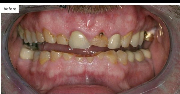 Full Mouth Reconstruction - Full Mouth Reconstruction.