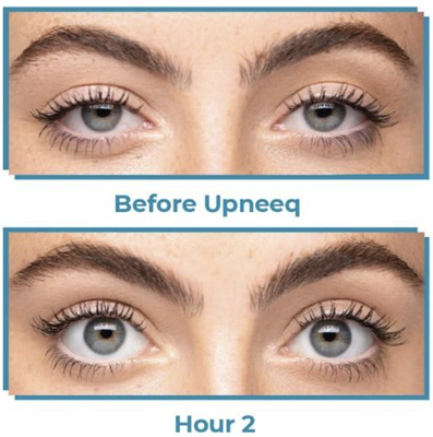 Upneeq - Eyelift Without Surgery! This common condition (also called low-lying lids) can impact adults of all ages. Low-lying lids may be caused by acquired blepharoptosis. Talk to your provider about getting UPLIFTED with Upneeq!
It is the only non-surgical and FDA-approved prescription eyedrop proven to rapidly lift upper eyelids in adults with acquired blepharoptosis. Upneeq - Eyelift Without Surgery! This common condition (also called low-lying lids) can impact adults of all ages. Low-lying lids may be caused by acquired blepharoptosis. Talk to your provider about getting UPLIFTED with Upneeq!
It is the only non-surgical and FDA-approved prescription eyedrop proven to rapidly lift upper eyelids in adults with acquired blepharoptosis.