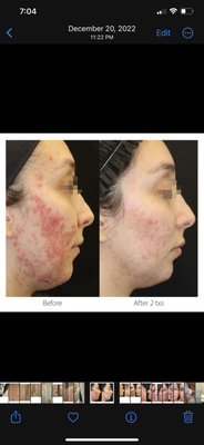 Acne Laser Treatments - Alma ClearSkin by Harmony XL Pro is the first technology to combine a non-ablative laser with simultaneous contact cooling and vacuum technology to effectively and safely treat acne and acne vulgaris to give you a revived and rejuvenated skin.
Combining ClearLift and DyeVL will treat all forms of acne vulgaris including papules, pustules and nodules, while also achieving a gentle rejuvenation effect, diminishing the appearance of acne scars by stimulating collagen renewal. Acne Laser Treatments - Alma ClearSkin by Harmony XL Pro is the first technology to combine a non-ablative laser with simultaneous contact cooling and vacuum technology to effectively and safely treat acne and acne vulgaris to give you a revived and rejuvenated skin.
Combining ClearLift and DyeVL will treat all forms of acne vulgaris including papules, pustules and nodules, while also achieving a gentle rejuvenation effect, diminishing the appearance of acne scars by stimulating collagen renewal.