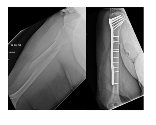 Proximal humerus and tibial plateau fractures - Examples of a proximal humerus and ankle fracture that underwent surgical fixation. Proximal humerus and tibial plateau fractures - Examples of a proximal humerus and ankle fracture that underwent surgical fixation.