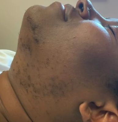 Chin Hair Waxing - We specialize in chin hair waxing. Call today to book!