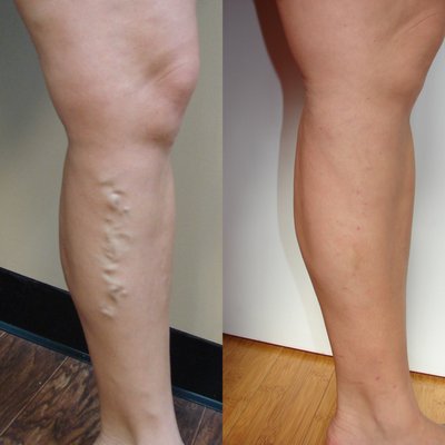 Before/After Patient Photos - This is a collection of actual pre and post-op patient photos. Our outpatient procedures generally take 45 minutes to an hour under local anesthesia.
