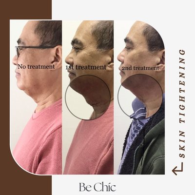 Body Contouring/Tightening - Our non-invasive body contouring which melts away your body fat without making any incisions in your skin!
Our machine works by using clinically proven modalities including radio-frequency energy and negative pressure applied to the skin and underlying fat. Body Contouring/Tightening - Our non-invasive body contouring which melts away your body fat without making any incisions in your skin!
Our machine works by using clinically proven modalities including radio-frequency energy and negative pressure applied to the skin and underlying fat.