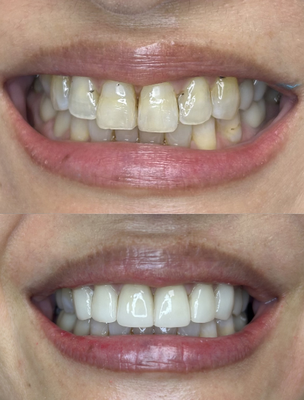 Before & Afters - Here are some before-and-after photos of restorative cases where patients were very pleased with their results. These treatments not only improved the esthetics of their smiles, but also restored function, supported long-term oral health, and contributed to their overall well-being. Before & Afters - Here are some before-and-after photos of restorative cases where patients were very pleased with their results. These treatments not only improved the esthetics of their smiles, but also restored function, supported long-term oral health, and contributed to their overall well-being.