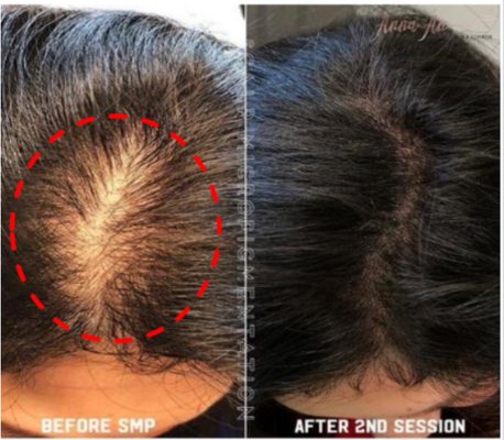 •Scalp Shading •Scalp Micropigmentation •Scalp Tattoo - Many individuals who suffer from hair loss have searched for years for an effective solution. Therefore, many clients who are interested in the procedure have already tried other methods including medication and hair transplant surgery. SMP can not only improve the appearance around the site of hair loss, but can also improve the appearance of old scars at the site of surgery.
In addition, SMP is a noninvasive and requires no surgical incisions. There is little recovery time or maintenance after the procedure, and no scarring. Contrary to hair transplant procedures, SMP allows for a lot more flexibility in designing and shaping the hairline, making it perfect for every stage of hair loss. Micropigmentation can deliver high density follicular restoration to the style, color and hair line preferences of the client. Lastly, the procedure is far more cost effective than hair transplant procedures, hair systems, and long-term OTC and prescription drugs. •Scalp Shading •Scalp Micropigmentation •Scalp Tattoo - Many individuals who suffer from hair loss have searched for years for an effective solution. Therefore, many clients who are interested in the procedure have already tried other methods including medication and hair transplant surgery. SMP can not only improve the appearance around the site of hair loss, but can also improve the appearance of old scars at the site of surgery.
In addition, SMP is a noninvasive and requires no surgical incisions. There is little recovery time or maintenance after the procedure, and no scarring. Contrary to hair transplant procedures, SMP allows for a lot more flexibility in designing and shaping the hairline, making it perfect for every stage of hair loss. Micropigmentation can deliver high density follicular restoration to the style, color and hair line preferences of the client. Lastly, the procedure is far more cost effective than hair transplant procedures, hair systems, and long-term OTC and prescription drugs.