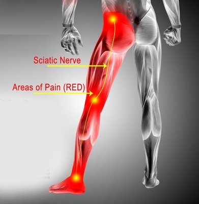 Sciatica Treatment - Relief from sciatic nerve pain begins with a diagnostic evaluation .This will identify the specific locations of any spinal subluxations. After a diagnosis of the cause of discomfort, D Simon will develop a customized treatment plan for you
Chiropractic treatment utilizes gentle, hands-on therapy without resorting to medication or surgery. Our clinic uses a variety of spinal manipulation techniques to resolve spinal misalignments responsible for sciatic pain.
These adjustments are a safe, effective way to target the cause of spinal discomfort. For some patients, combining them with hydro massage, physical therapy, or both is helpful. Give us a call today for a free consultation at (404) 634-1669 Sciatica Treatment - Relief from sciatic nerve pain begins with a diagnostic evaluation .This will identify the specific locations of any spinal subluxations. After a diagnosis of the cause of discomfort, D Simon will develop a customized treatment plan for you
Chiropractic treatment utilizes gentle, hands-on therapy without resorting to medication or surgery. Our clinic uses a variety of spinal manipulation techniques to resolve spinal misalignments responsible for sciatic pain.
These adjustments are a safe, effective way to target the cause of spinal discomfort. For some patients, combining them with hydro massage, physical therapy, or both is helpful. Give us a call today for a free consultation at (404) 634-1669