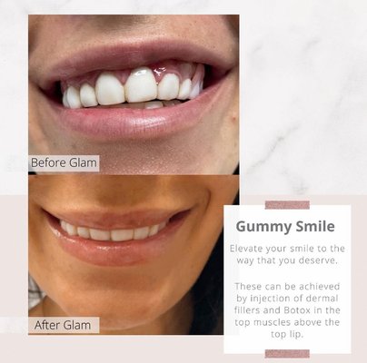 Gummy Smile - Gummy Smile before and after