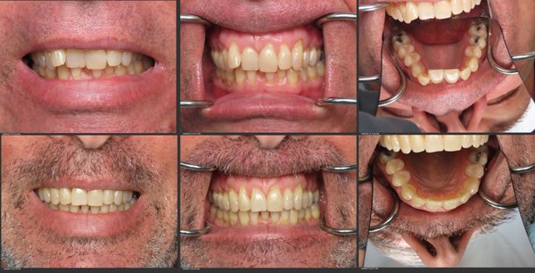 Invisalign - Before and After pictures of invisalign treatment. Invisalign - Before and After pictures of invisalign treatment.